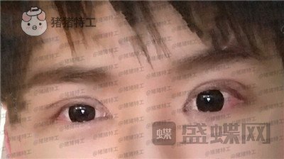 北京美莱余辉眼部手术案例价格分享,这个男生做完眼睛好像吴磊有没有?