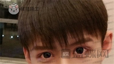 北京美莱余辉眼部手术案例价格分享,这个男生做完眼睛好像吴磊有没有?