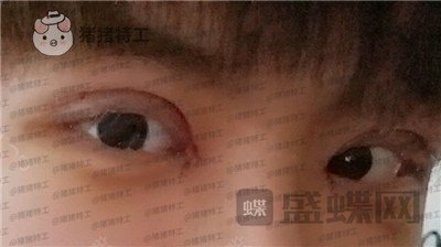 北京美莱余辉眼部手术案例价格分享,这个男生做完眼睛好像吴磊有没有?