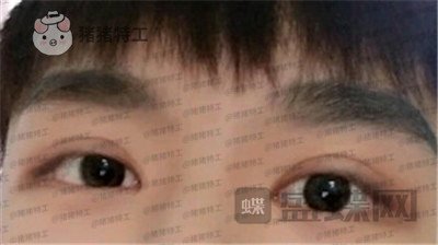 北京美莱余辉眼部手术案例价格分享,这个男生做完眼睛好像吴磊有没有?