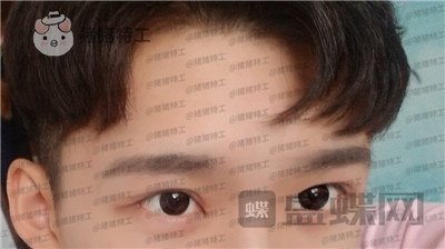 北京美莱余辉眼部手术案例价格分享,这个男生做完眼睛好像吴磊有没有?
