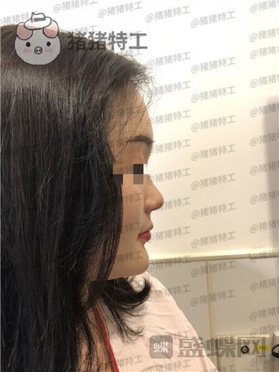 上海百达丽原九院沈国雄隆鼻案例价格分享,九院的医生果然技术不同凡响。
