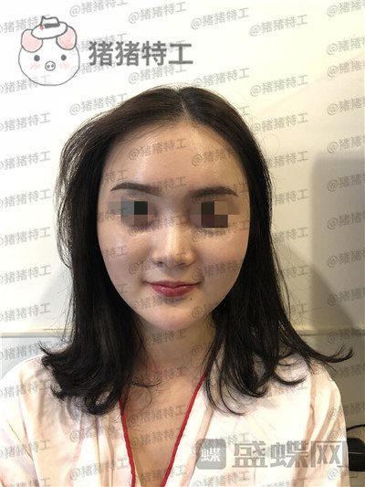 上海百达丽原九院沈国雄隆鼻案例价格分享,九院的医生果然技术不同凡响。