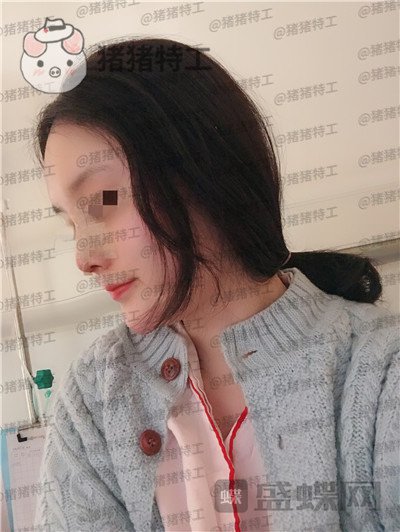 上海百达丽原九院沈国雄隆鼻案例价格分享,九院的医生果然技术不同凡响。