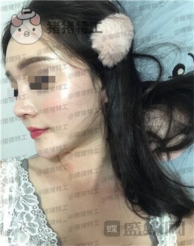 上海百达丽原九院沈国雄隆鼻案例价格分享,九院的医生果然技术不同凡响。