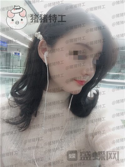 上海百达丽原九院沈国雄隆鼻案例价格分享,九院的医生果然技术不同凡响。