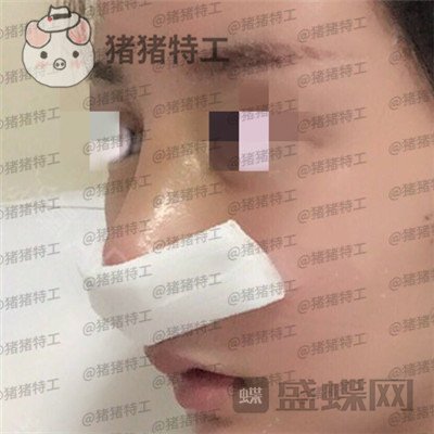 北京八大处王欢鼻修复案例价格分享,这么失败的鼻子以为没救了多谢医生妙手回春~