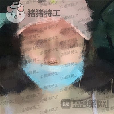 北京八大处王欢鼻修复案例价格分享,这么失败的鼻子以为没救了多谢医生妙手回春~