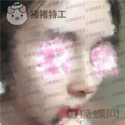 北京八大处王欢鼻修复案例价格分享,这么失败的鼻子以为没救了多谢医生妙手回春~