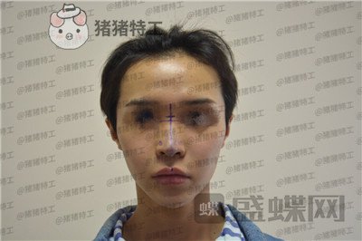 成都西区医院车红昌鼻部手术案例价格分享,惊奇转脸蔡徐坤这波颜值你服吗?