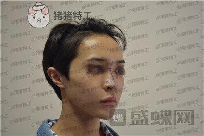 成都西区医院车红昌鼻部手术案例价格分享,惊奇转脸蔡徐坤这波颜值你服吗?