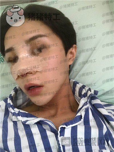 成都西区医院车红昌鼻部手术案例价格分享,惊奇转脸蔡徐坤这波颜值你服吗?