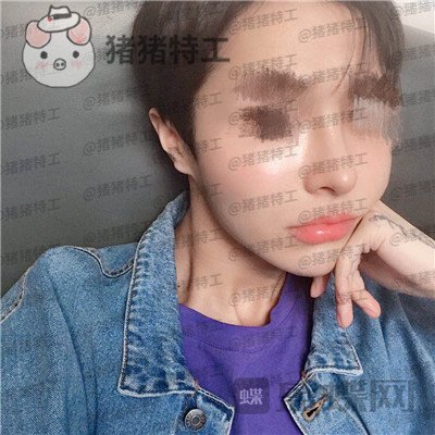 成都西区医院车红昌鼻部手术案例价格分享,惊奇转脸蔡徐坤这波颜值你服吗?