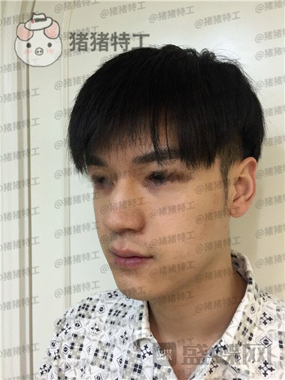 北京美莱黄罡隆鼻驼峰鼻修正案例价格分享,论男生有一个好看的鼻子有多重要?