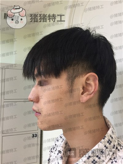 北京美莱黄罡隆鼻驼峰鼻修正案例价格分享,论男生有一个好看的鼻子有多重要?