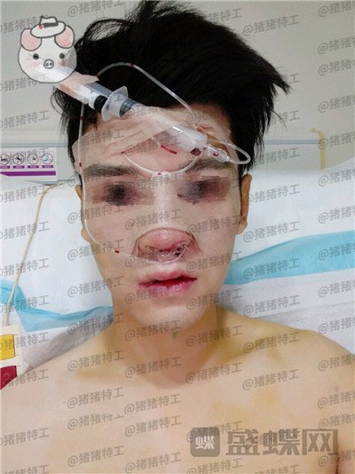 北京美莱黄罡隆鼻驼峰鼻修正案例价格分享,论男生有一个好看的鼻子有多重要?