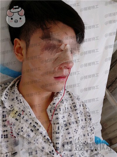北京美莱黄罡隆鼻驼峰鼻修正案例价格分享,论男生有一个好看的鼻子有多重要?