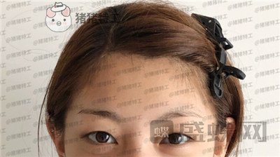 杭州美莱张霞飞双眼皮案例价格分享,外婆看到我割了双眼皮心疼的哭了~