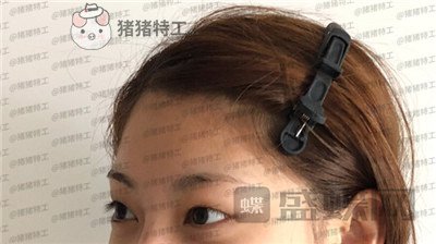 杭州美莱张霞飞双眼皮案例价格分享,外婆看到我割了双眼皮心疼的哭了~