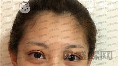 杭州美莱张霞飞双眼皮案例价格分享,外婆看到我割了双眼皮心疼的哭了~