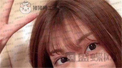 杭州美莱张霞飞双眼皮案例价格分享,外婆看到我割了双眼皮心疼的哭了~