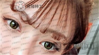杭州美莱张霞飞双眼皮案例价格分享,外婆看到我割了双眼皮心疼的哭了~