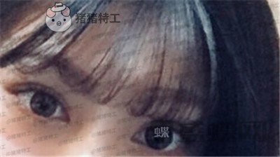 杭州美莱张霞飞双眼皮案例价格分享,外婆看到我割了双眼皮心疼的哭了~