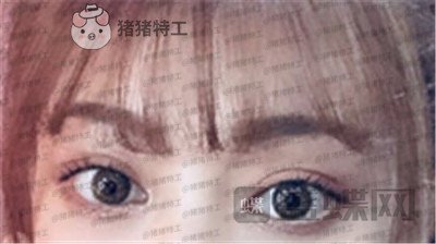 杭州美莱张霞飞双眼皮案例价格分享,外婆看到我割了双眼皮心疼的哭了~
