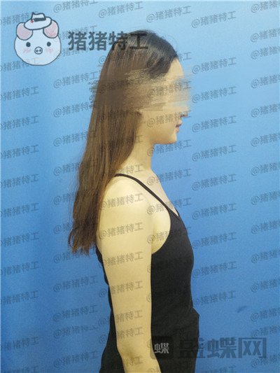 南京美贝尔张永升隆胸案例价格分享,飞机场能做出这样的果真的很惊艳了~