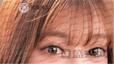 杭州美莱张霞飞双眼皮案例价格分享,外婆看到我割了双眼皮心疼的哭了~