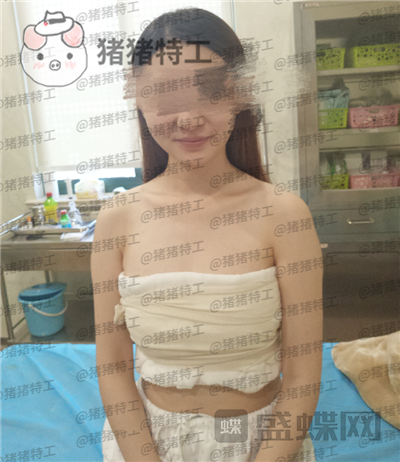南京美贝尔张永升隆胸案例价格分享,飞机场能做出这样的果真的很惊艳了~