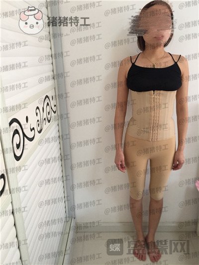 重庆万家燕王珍祥吸脂案例价格分享,水桶腰成功逆袭A4腰令人心动~