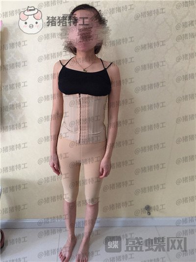 重庆万家燕王珍祥吸脂案例价格分享,水桶腰成功逆袭A4腰令人心动~