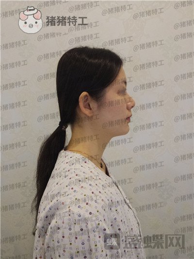 南京美贝尔黄名斗鼻部手术案例价格分享,做完受到太多赞美整个人自信了很多~