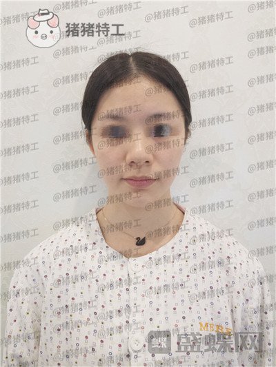南京美贝尔黄名斗鼻部手术案例价格分享,做完受到太多赞美整个人自信了很多~