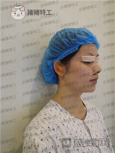 南京美贝尔黄名斗鼻部手术案例价格分享,做完受到太多赞美整个人自信了很多~
