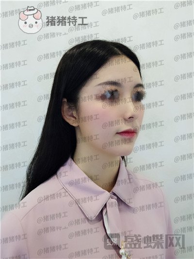 南京美贝尔黄名斗鼻部手术案例价格分享,做完受到太多赞美整个人自信了很多~