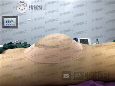 深圳仁安雅苗春来丰臀案例价格分享,火辣性感这些词放在这身材上都恰当好。