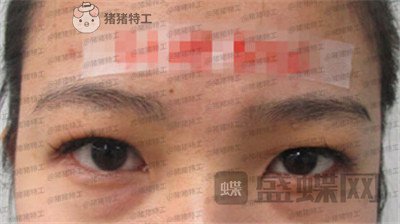 成都素美杨迪眼部手术案例价格分享,拍的照片好多被盗图是因为太好看了吗?