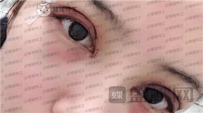 成都素美杨迪眼部手术案例价格分享,拍的照片好多被盗图是因为太好看了吗?