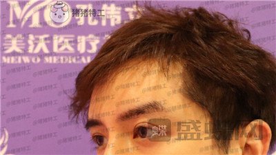 长沙美沃孔伟立双眼皮修复案例价格分享,这是林更新本人吗眼睛太好看了!