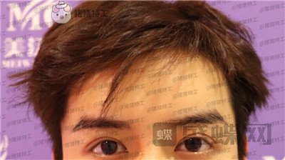 长沙美沃孔伟立双眼皮修复案例价格分享,这是林更新本人吗眼睛太好看了!