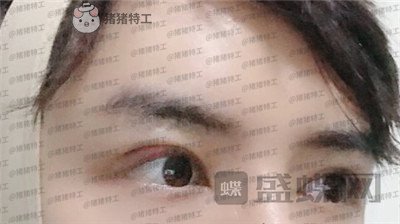 长沙美沃孔伟立双眼皮修复案例价格分享,这是林更新本人吗眼睛太好看了!