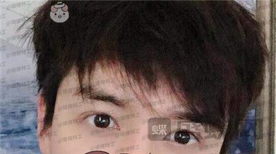长沙美沃孔伟立双眼皮修复案例价格分享,这是林更新本人吗眼睛太好看了!
