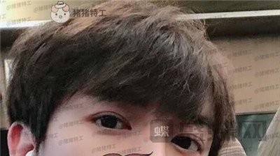 长沙美沃孔伟立双眼皮修复案例价格分享,这是林更新本人吗眼睛太好看了!