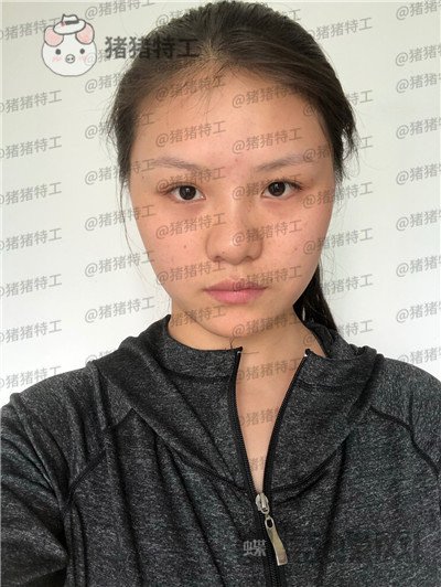 兰州亚韩李军梅隆鼻案例价格分享,做耳软骨隆鼻是一种什么体验?