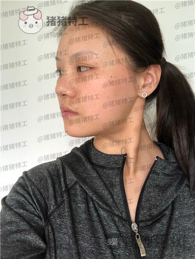 兰州亚韩李军梅隆鼻案例价格分享,做耳软骨隆鼻是一种什么体验?