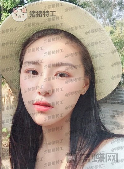 兰州亚韩李军梅隆鼻案例价格分享,做耳软骨隆鼻是一种什么体验?