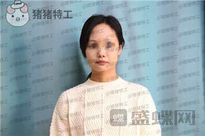 沈阳杏林朱石江下颌角磨骨案例价格分享,磨骨手术好像没有想象中的那么可怕~