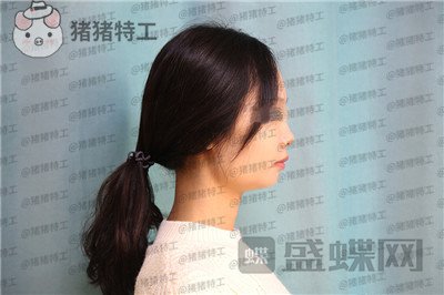 沈阳杏林朱石江下颌角磨骨案例价格分享,磨骨手术好像没有想象中的那么可怕~
